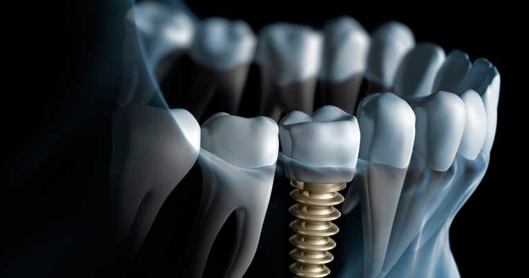 ¿Qué son los implantes dentales?