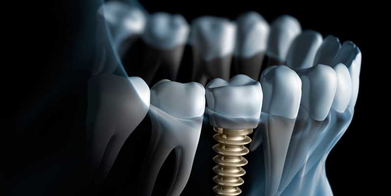 ¿Qué son los implantes dentales?