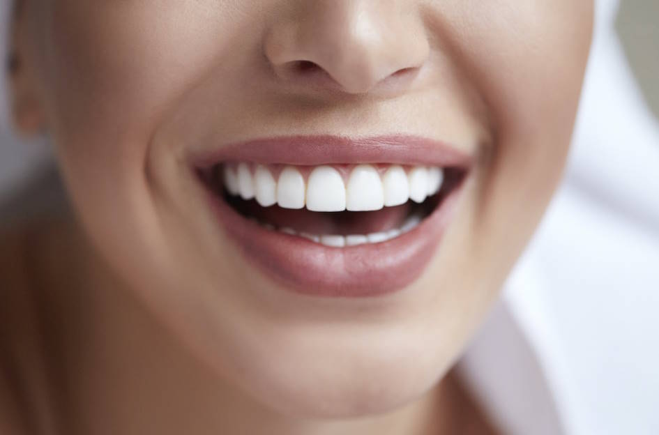 carillas dentales precios