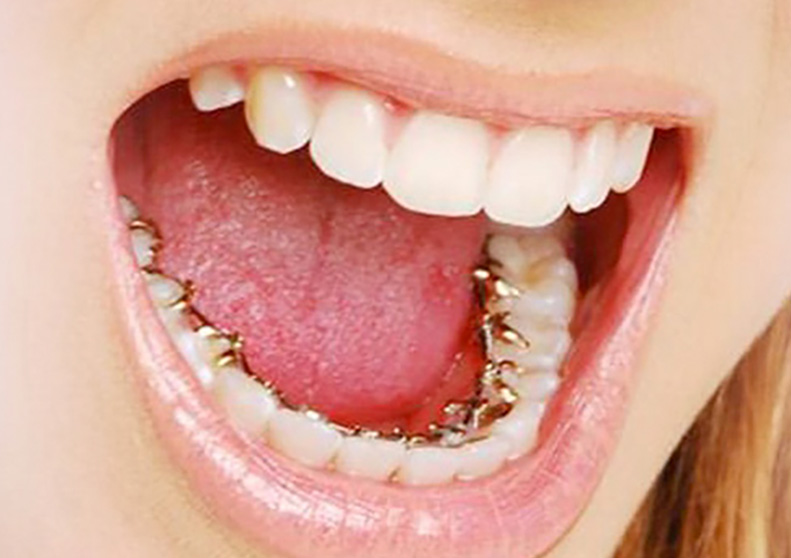 ortodoncia brackets madrid ortodoncia brackets madrid
