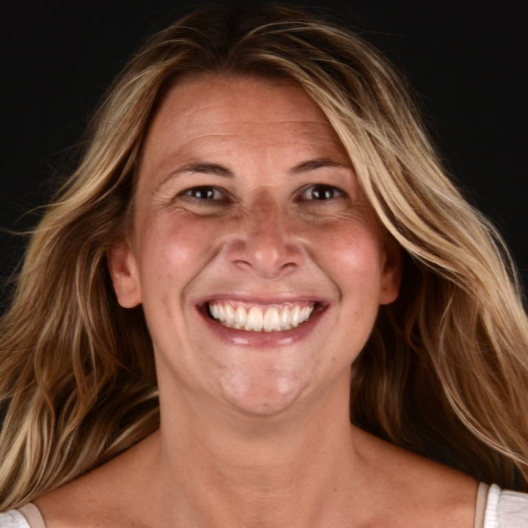 Antes y después de diseño de sonrisa natural con carillas dentales en Madrid - Caso real Q-Dental.
