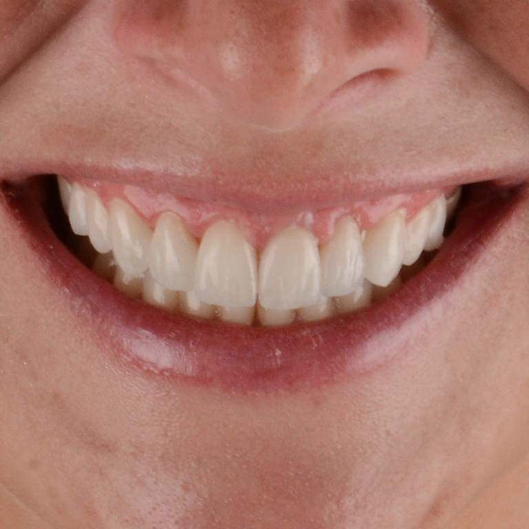 Antes y después de diseño de sonrisa natural con carillas dentales en Madrid - Caso real Q-Dental.
