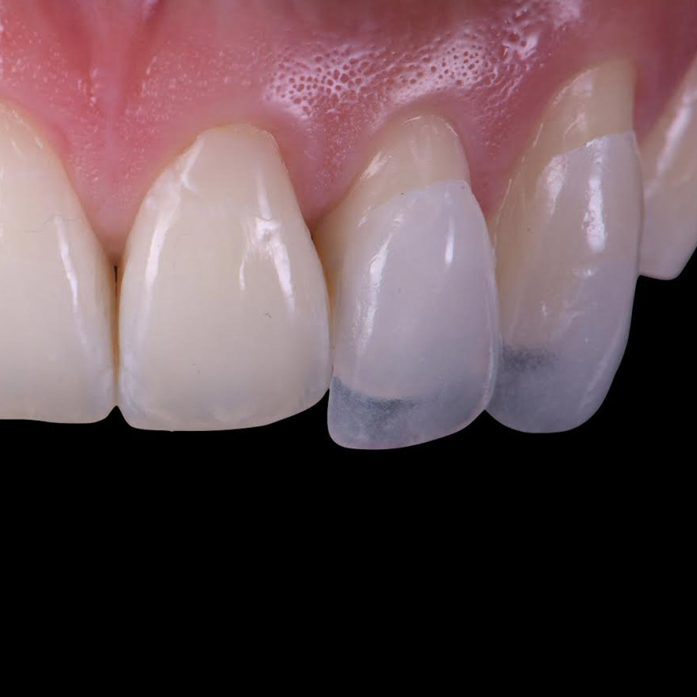 carillas dentales madrid