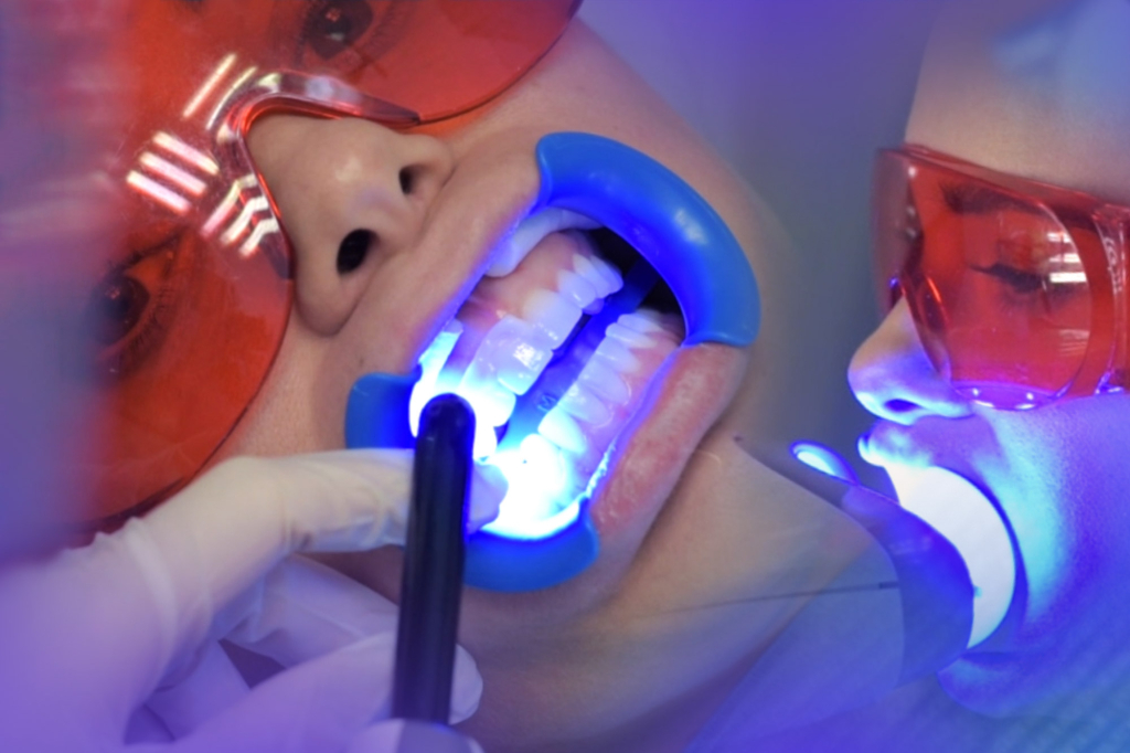 Láser Dental blanqueamiento Madrid