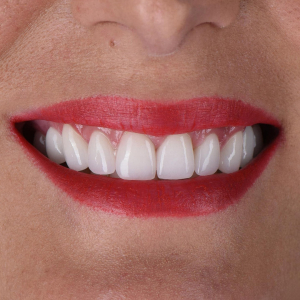 Antes y después de diseño de sonrisa natural con carillas dentales en Madrid - Caso real Q-Dental.