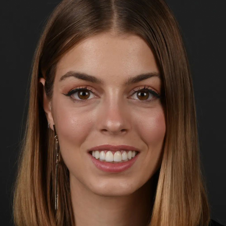 Antes y después del diseño de sonrisa natural de la cantante Nerea Rodríguez en Clínica Q-Dental Madrid.