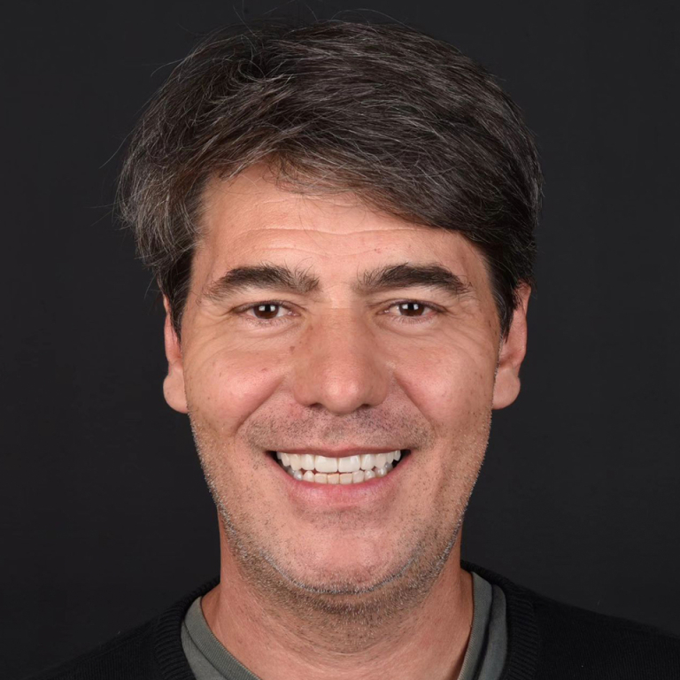 Antes y después de diseño de sonrisa natural con carillas dentales en Madrid - Caso real Q-Dental.