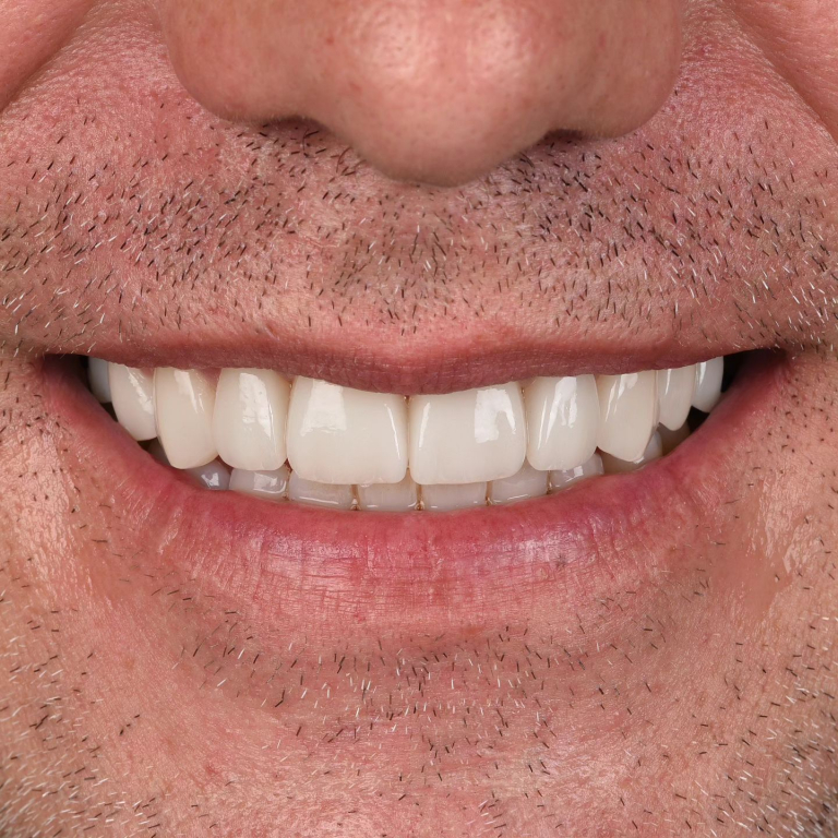 Antes y después de diseño de sonrisa natural con carillas dentales en Madrid - Caso real Q-Dental.