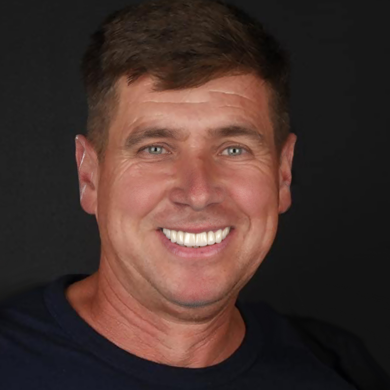 Antes y después de implantes dentales: recuperación de sonrisa y funcionalidad en Q-Dental Madrid.