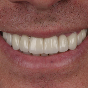 Antes y después de implantes dentales: recuperación de sonrisa y funcionalidad en Q-Dental Madrid.