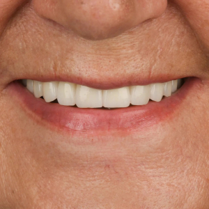 Antes y después de implantes dentales: recuperación de sonrisa y funcionalidad en Q-Dental Madrid.