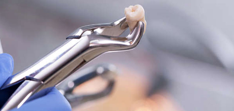 extraccion dental madrid simple extraccion dental madrid simple