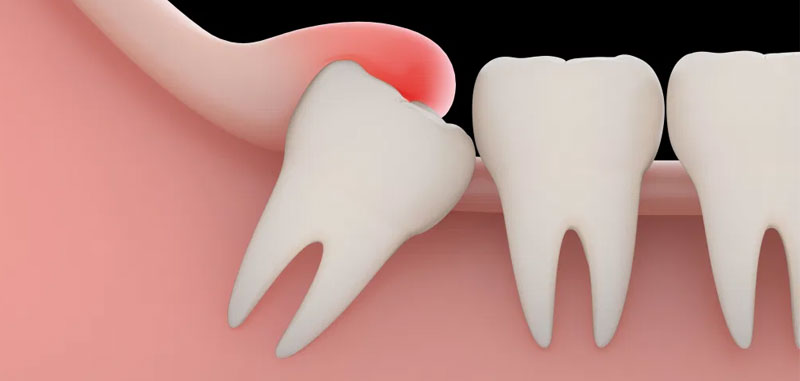 extracciones dentales madrid extracciones dentales madrid