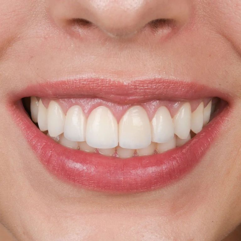 Antes y después del diseño de sonrisa natural de la cantante Nerea Rodríguez en Clínica Q-Dental Madrid.